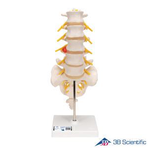 3B Scientific 인체모형 A76/5 후외측 배측방 디스크 요추 Dorso-Lateral Prolapsed