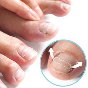 퍼펙토 페디 스트립 패치 테이프 세트 내성발톱 파고드는발톱 (10매/20매)