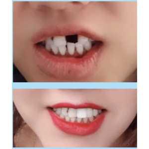 임시치아만들기 임시이빨 이빨 홈매우기 치아