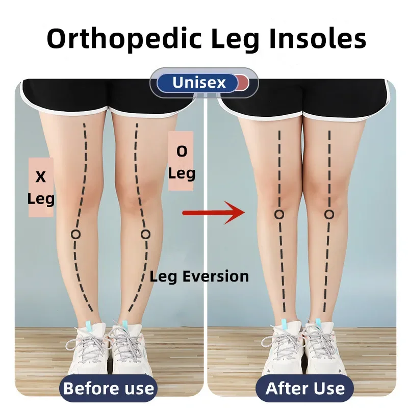 발용 실리콘 정형 안창 O/X 다리 유형 Valgus Varus 교정 발바닥 근막염 젤 깔창 자석 마사지 풋 케어