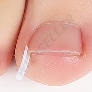 내성발톱 셀프치료 관리교정기 교정팁 보호기 고정스틱 고정지지대 파고드는발톱 자가치료스트립 내향성발