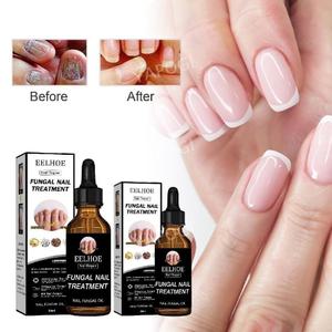 조갑사상균증 개선 에센스 대용량 50ml 손톱 발톱 강화제 영양제 리페어