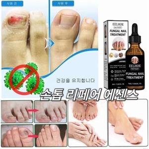 1+1 두꺼운발톱치료제 조갑사상균증 개선 손톱 리페어 에센스 발 발톱 영양제 손톱 발
