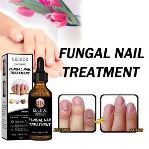EELHOE 50ml 3개 발톱무좀 조갑사상균증 개선 에산스