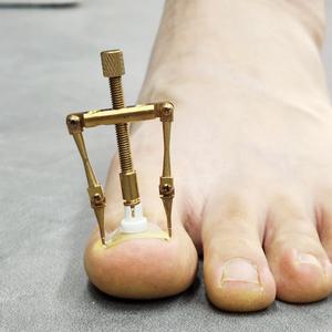 링쿠 내성발톱 교정기 치료 교정 파고드는 내향성 발톱 테이프 세트 밴드 RX-55