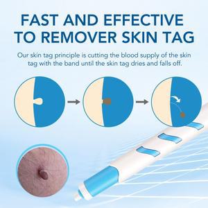 작은 피부 태그 제거 키트 (1-4mm 태그용) 클렌징 스왑 포함 가정용 뷰티 얼굴 관리 도구