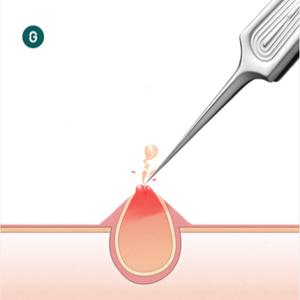 [미스터그린 공식몰]여드름 압출기 족집게 프리머엄 독일의료용 스테인레스 블랙헤드 핀셋 피지