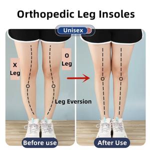 발용 실리콘 정형 안창 O/X 다리 유형 Valgus Varus 교정 발바닥 근막염 젤 깔창 자석 마사지 풋 케어