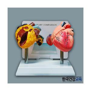 금연교육용품-흡연자의 심장비교모형