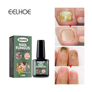 발톱무좀 치료 무좀 진균 약 리페어 에센스 발냄새없애는법