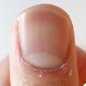 손거스러미영양제 손톱 거스러미 크림 갈라짐 영양제 발톱연화제