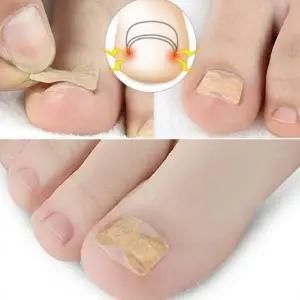 발톱밴드50p발톱테이프 발톱고정 발톱테이프 발톱발톱밴드