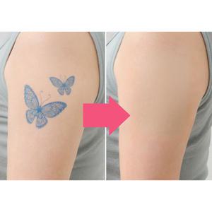 소형출시 타투가리기/멍 흉터 커버시트/7일지속사용