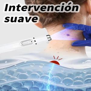 사마귀 치료 도구, 신체 뜨거운 판매 상품인 블루 라이트 펜