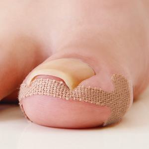 내향성 내성 발톱 자가 치료 파고드는 밴드 테이프 교정기 4P