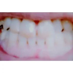 치아도금면봉 치석방지제면 치미백제면 보철부식방지 임플란트코팅면 의치청결 시린이방지봉 치주염예방 알로에나노면봉