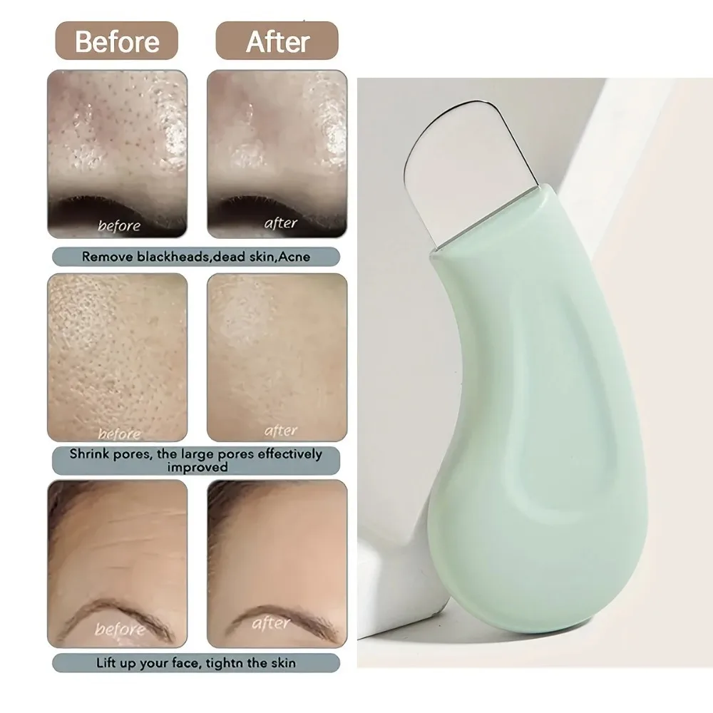 코와 얼굴용 블랙헤드 및 화이트헤드 제거 도구 - 여성용 피부 모공 클리너 스킨 케어 도구