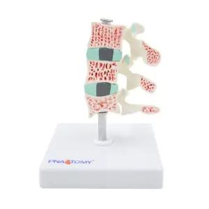 정형외과 척추 질병 모형 골다공증 분리형 관찰 실습용 간호사 교육기자재