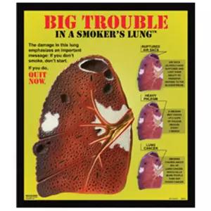 HEALTH EDCO 모형 [HEALTH EDCO] 흡연자의 폐모형 DISPLAY 79670 3-D