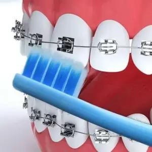 V컷 교정칫솔 개별포장 틈새교정기 어금니 교정용치솔 WE89231