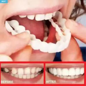 실리콘틀니 임시치아 가짜이빨 노인모조보철홈메우기 인공부분앞니재료 의치