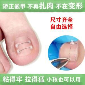 내성 발톱 교정기 파고드는 1세트 테이프 셀프교정기 핀처 와이어 스트립 교정팁 밴드 내향성