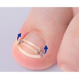 감갑교정기 상자 15mm 내성발톱 밴드 와이어 버클 스프링 20mm 자동 5 MG 대용량 95형