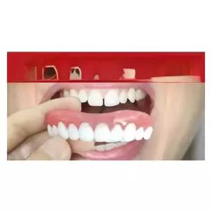 가짜 앞니 임시 치아 이빨 교정 보조 의치 틀니 윗니