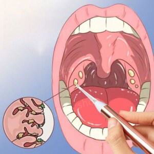 편도결석제거기 편도 흡입기 입똥 치석 입똥제거 1인분 셀프 편도결석흡입기 이물질 흡입력