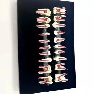 치아 모형 유치와 의사 환자 간의 소통 유치와 영구치를 보여줌