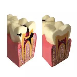 충치 단면 확대 치아 이빨 치과 모형 학습교구 교육용