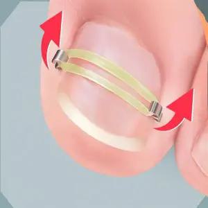 내성발톱 포도 스트립 발가락 교정기 설치쉬운 보호대 양발사용