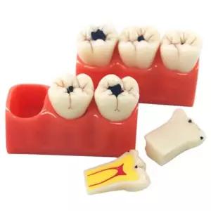 병원 학교 보건 교육용 어금니 3배확대형 치아 충치모형 분리형 수업용