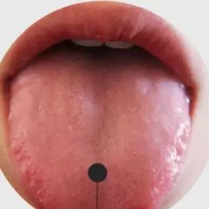 5세대혀클리너 혀 갈라짐 돌기 닦는칫솔 백태제거제