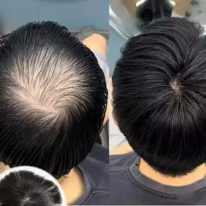 남성용 100 인모 정수리 가발 원형 탈모 앞머리 커버