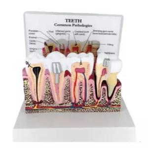 충치 염증 교육용 치과 정밀 치아 모형 이빨 신체