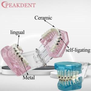 교정용 임플란트 잇몸 치아 모형 금속 세라믹 교정기 레진 치과 의사 재료 교육용 학습