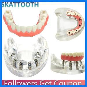 치과 낮은 치아 임플란트 모델 Overdenture 의료 의사 교육 연구를위한 이동식