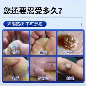 붙이는 티눈밴드 티눈고 1박스 제거 사이즈 아이패치 밴드 1패치 휴대용