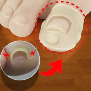 내성 발톱 셀프 치료 파고드는 테이프 밴드 영양제 내향성 케어 관리 교정기 1+1