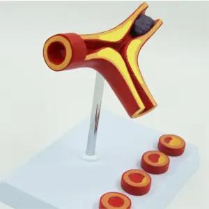 보건교육용 4단계 동맥경화 혈관모형 교구