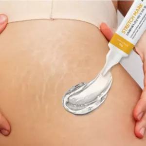 출산후 튼살 크림 오일 오래된 흰색 붉은 튼살 제거