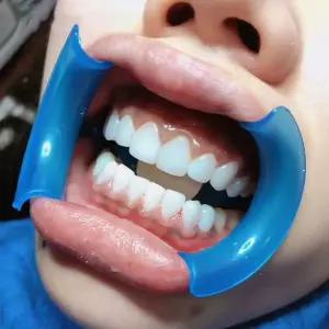 개구기 확장기 개구 치아 미백 구강 오프너 장치