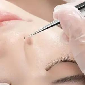 초미세 핀포인트 미용 제거기 족집게 제거 클립 피지