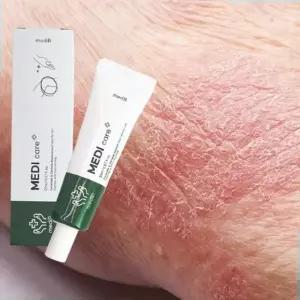 한포진 건성 피부 진정 크림 건선 가려움증 진물 습진