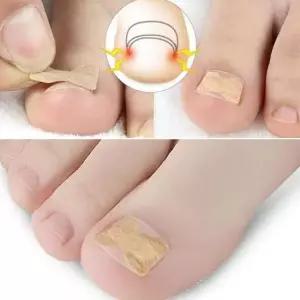 엄지발톱 발톱테이프 말린발 발톱밴드50p