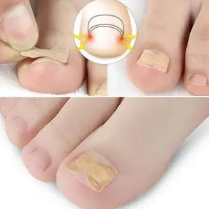 발톱밴드50p 발톱테이프 발톱테이프 엄지발톱 말린발톱 스티커