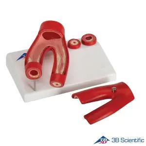 [종로의료기]3B Scietific 동맥경화증모형 동맥의 횡단면 G40 2파트분리 4단계표현