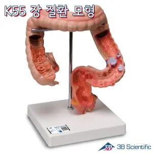 [종로의료기]3B Scientific 인체모형 장질환모형 K55 결장과 직장사이의 각종 변병표현