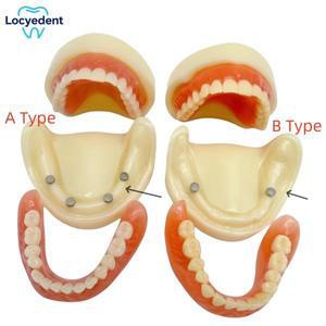 치과 전체 틀니 모델 오버덴추어 자기 부착물 턱 아래/위 연구 교육